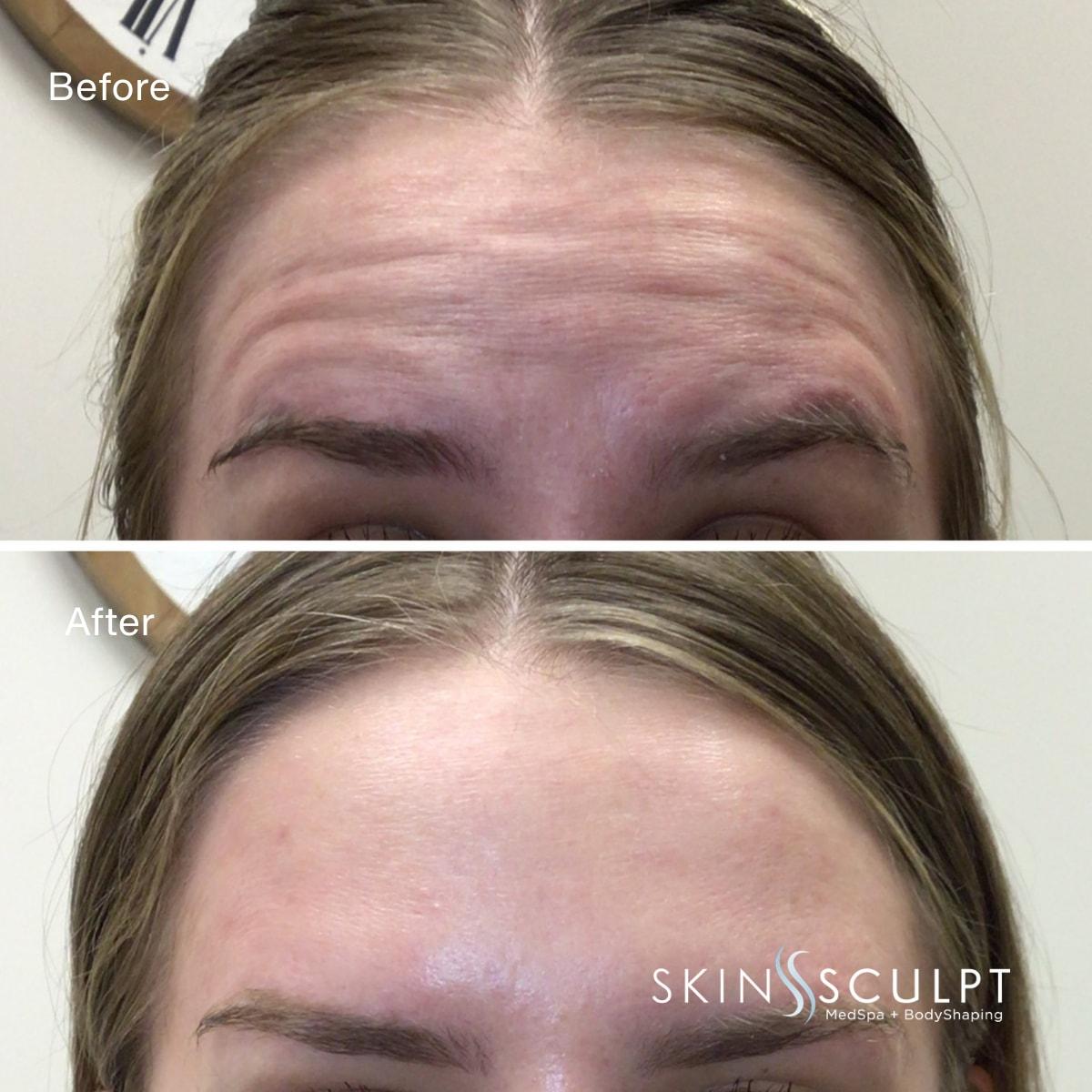 SkinSculpt MedSpa + BodyShaping botox result — South Ogden, UT