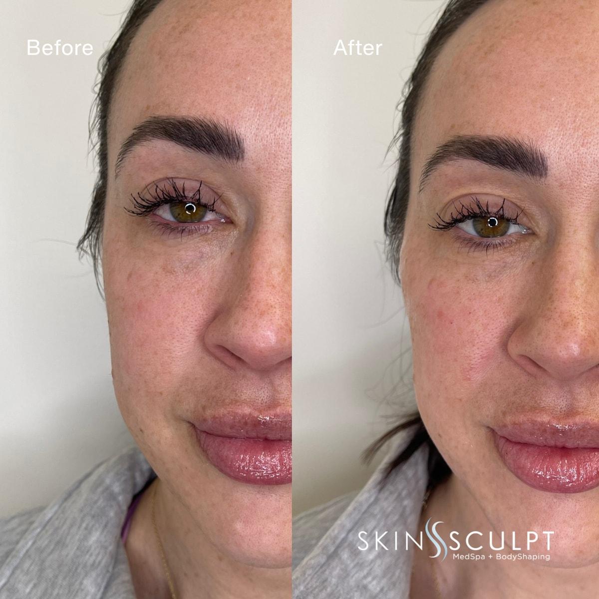 SkinSculpt MedSpa + BodyShaping under-eye filler result — South Ogden, UT