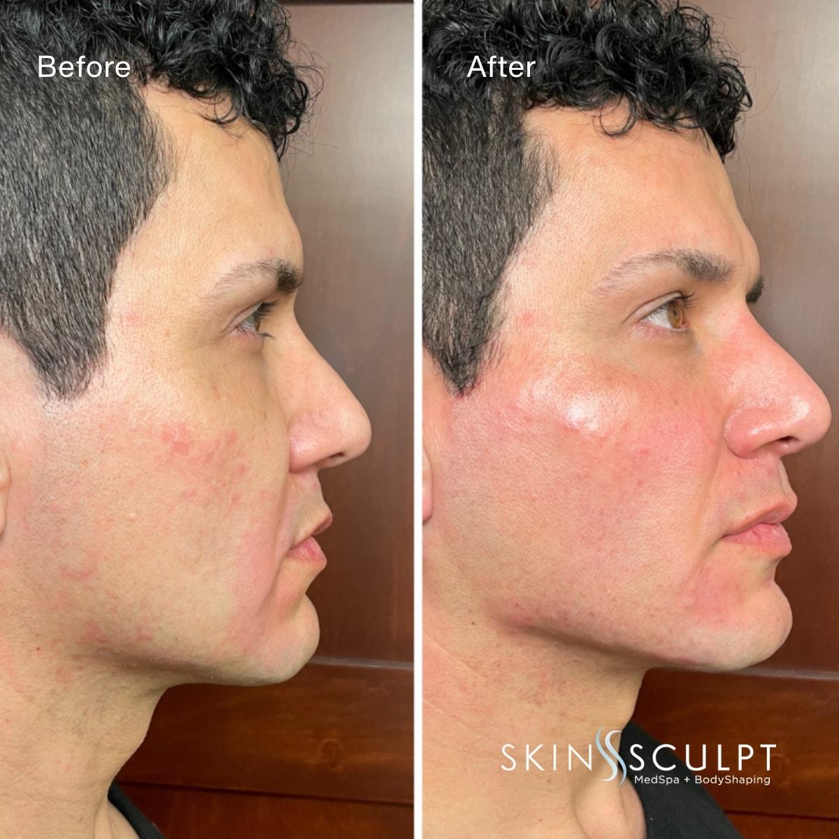 SkinSculpt MedSpa + BodyShaping jawline filler result — South Ogden, UT
