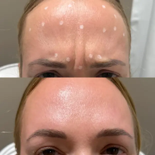 SkinSculpt MedSpa + BodyShaping botox result — South Ogden, UT