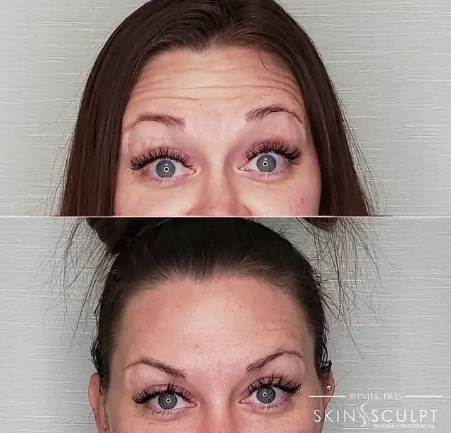 Botox result at SkinSculpt MedSpa + BodyShaping in South Ogden, UT