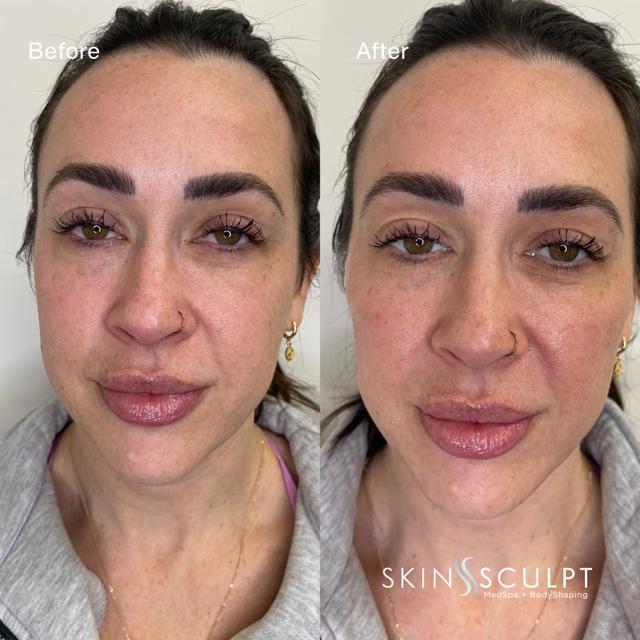 Jawline Filler result at SkinSculpt MedSpa + BodyShaping in South Ogden, UT