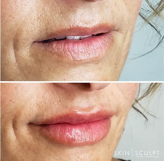 SkinSculpt MedSpa + BodyShaping lip filler result — South Ogden, UT