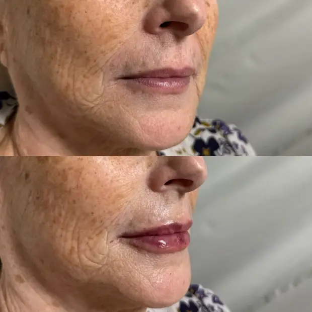 SkinSculpt MedSpa + BodyShaping lip filler result — South Ogden, UT