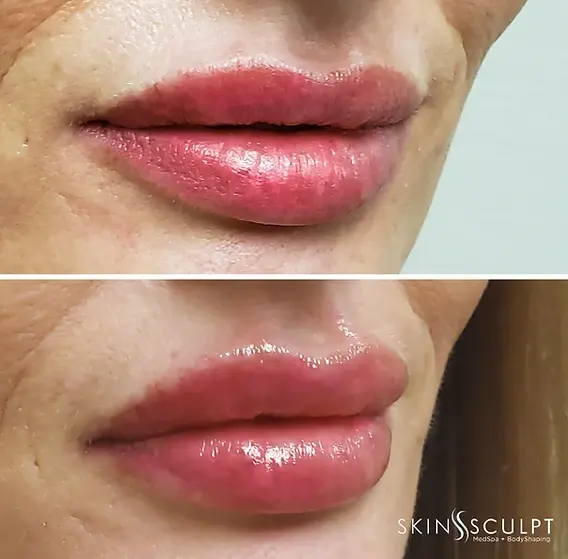 SkinSculpt MedSpa + BodyShaping lip filler result — South Ogden, UT