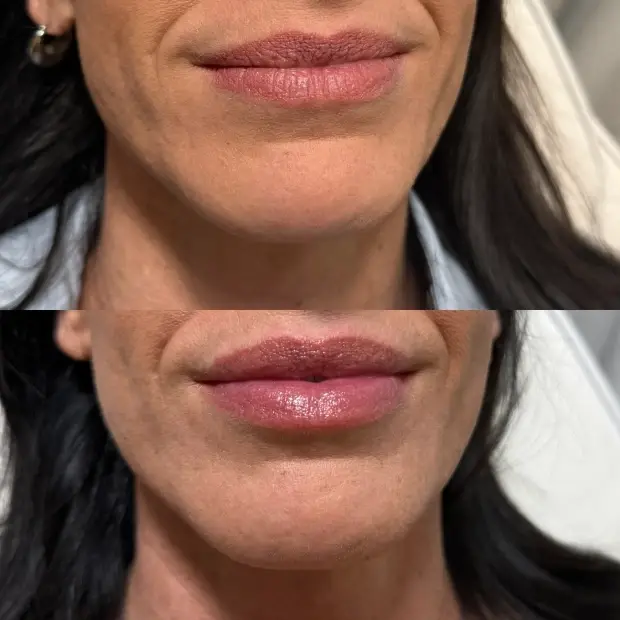 SkinSculpt MedSpa + BodyShaping lip filler result — South Ogden, UT