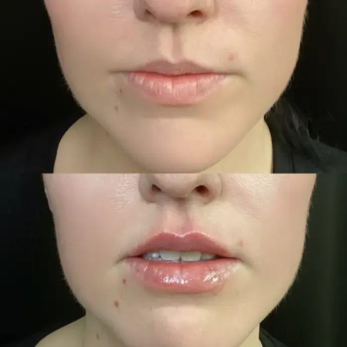 SkinSculpt MedSpa + BodyShaping lip filler result — South Ogden, UT