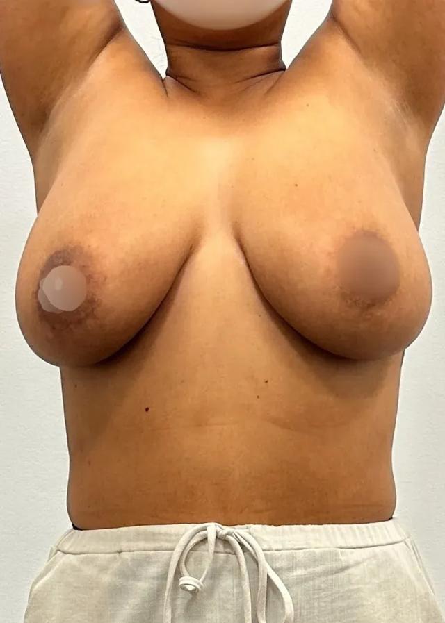 Breast Reduction before at Empowered Plastic Surgery in Sugar Land, TX