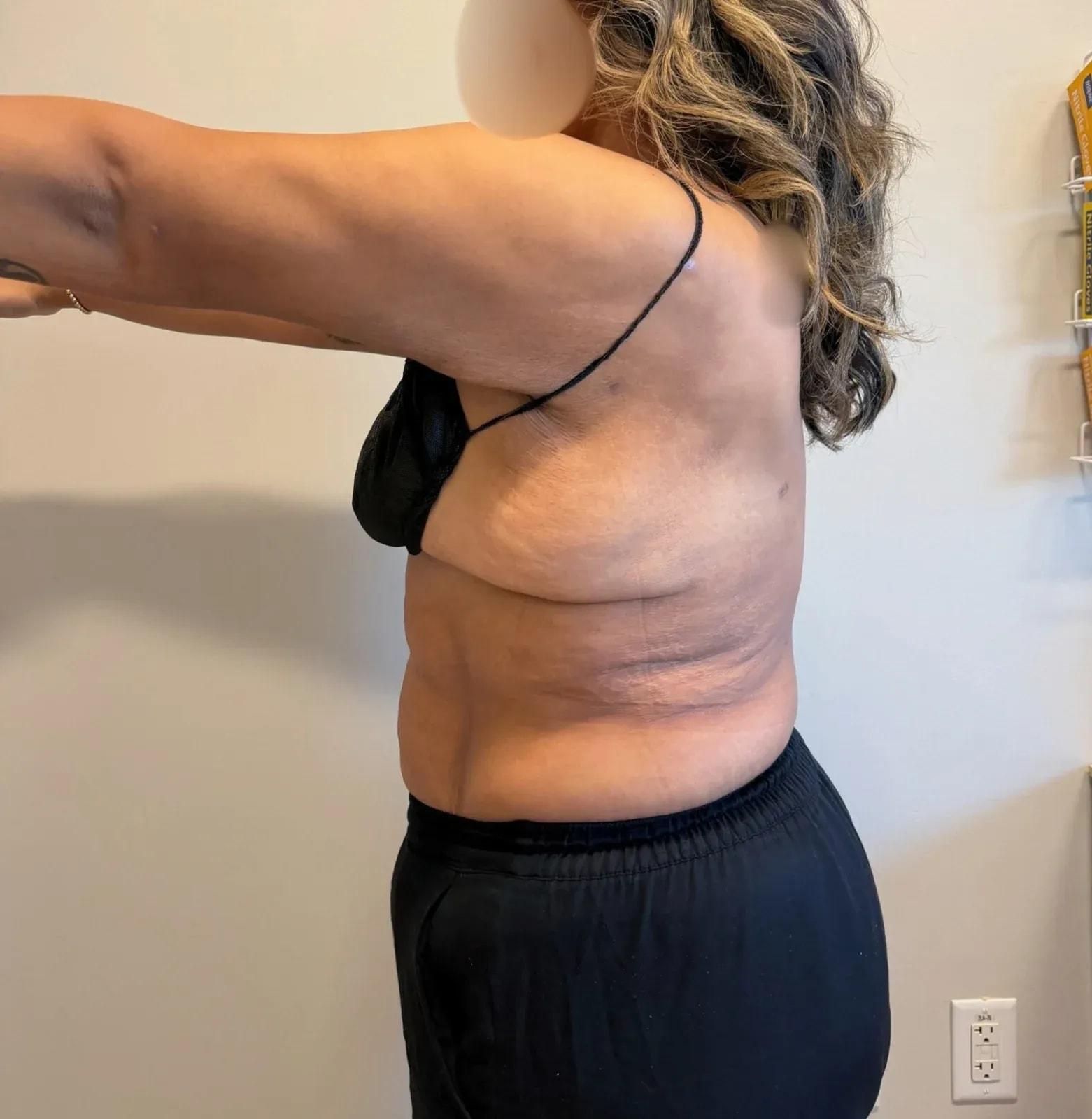 Empowered Plastic Surgery liposuction after — Sugar Land, TX