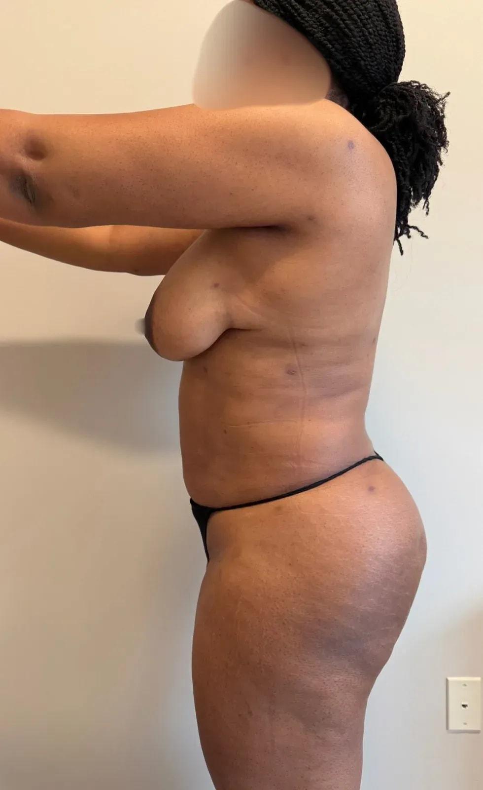 Empowered Plastic Surgery liposuction after — Sugar Land, TX
