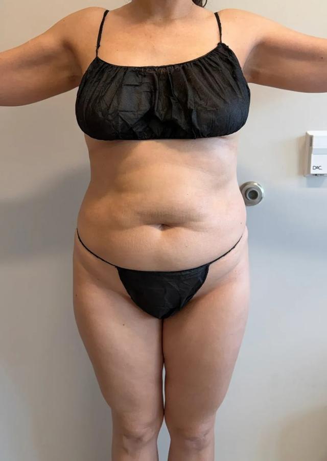 Liposuction before at Empowered Plastic Surgery in Sugar Land, TX