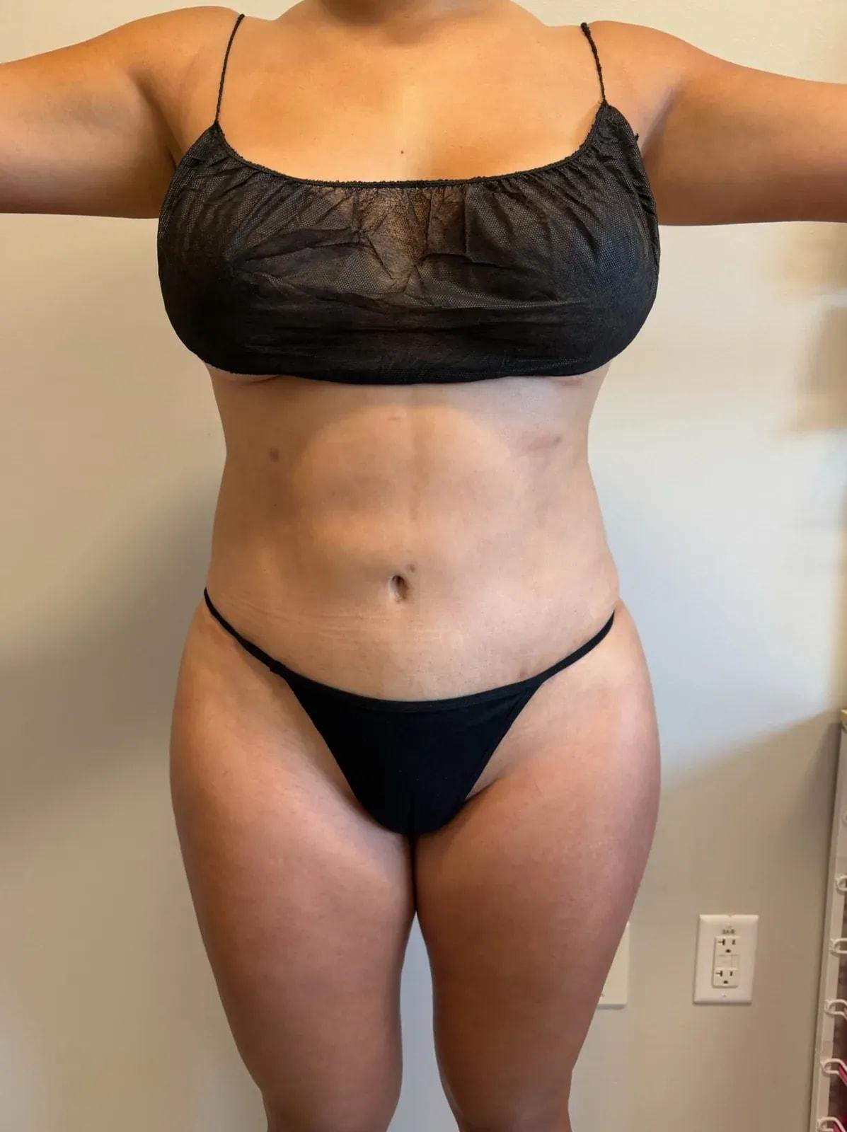 Empowered Plastic Surgery liposuction after — Sugar Land, TX