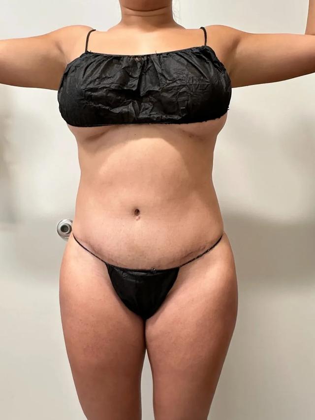 Liposuction before at Empowered Plastic Surgery in Sugar Land, TX