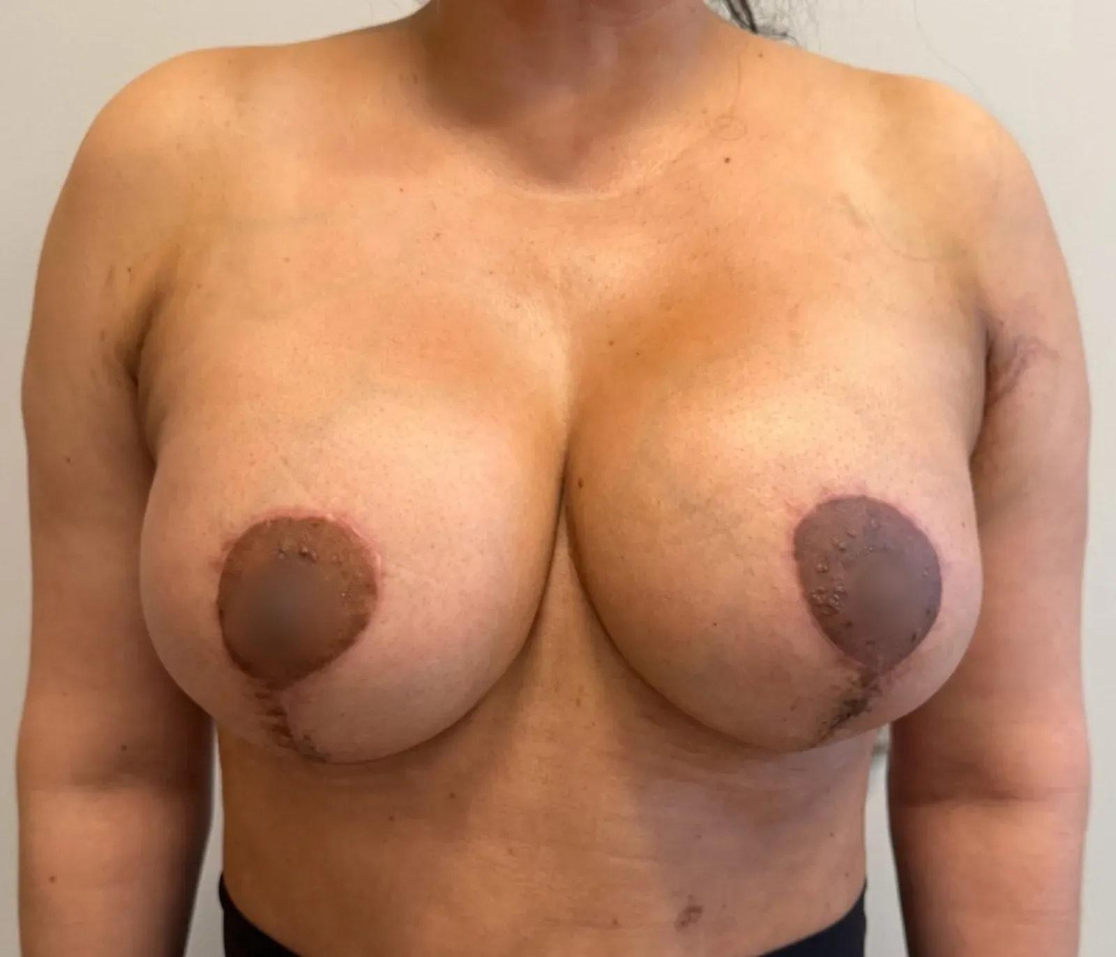 Empowered Plastic Surgery breast lift after — Sugar Land, TX