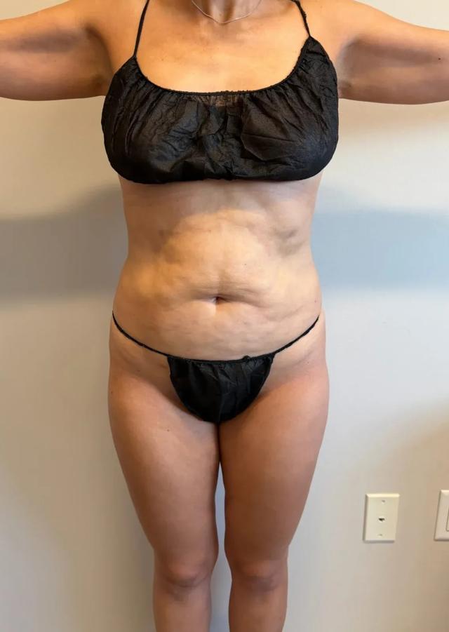 Liposuction after at Empowered Plastic Surgery in Sugar Land, TX