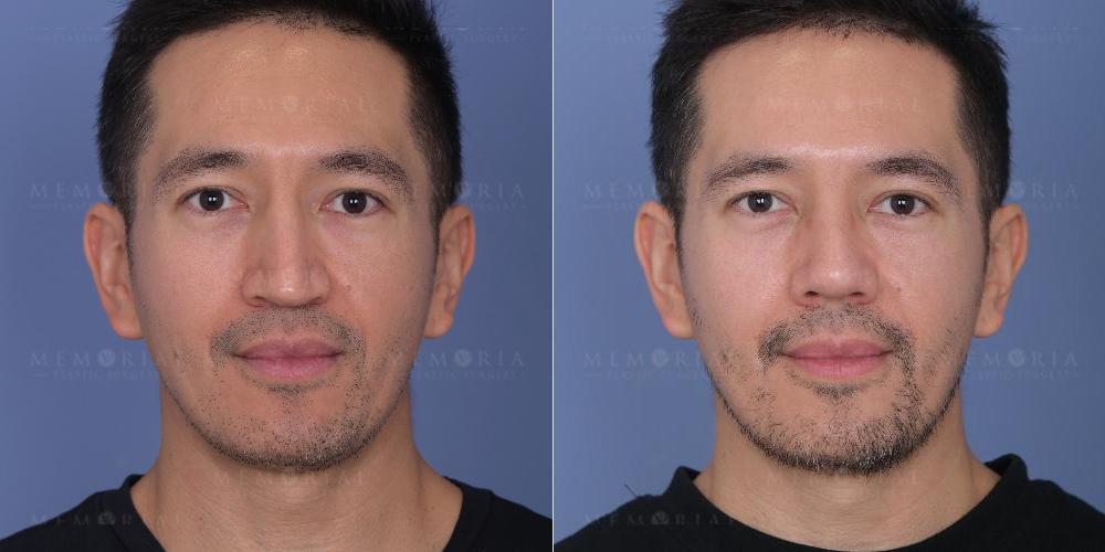 Memorial Plastic Surgery rhinoplasty result — Houston, TX