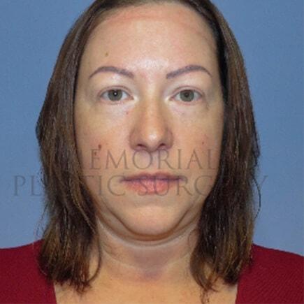 Neck Lift before at Memorial Plastic Surgery in Houston, TX
