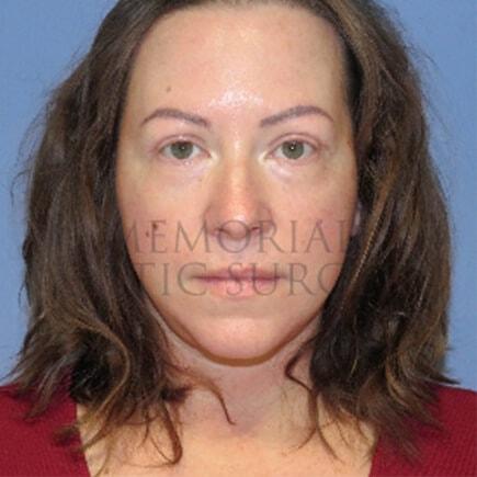 Neck Lift after at Memorial Plastic Surgery in Houston, TX