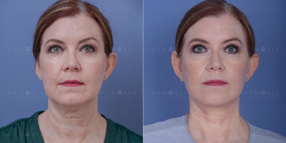 Memorial Plastic Surgery blepharoplasty result — Houston, TX