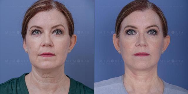 Facelift result at Memorial Plastic Surgery in Houston, TX