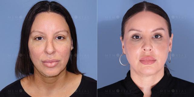 Liquid Rhinoplasty result at Memorial Plastic Surgery in Houston, TX
