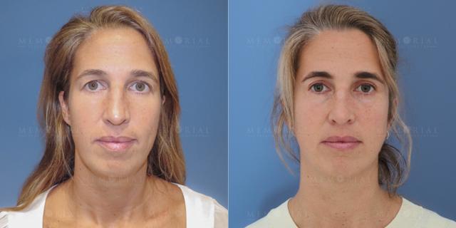Blepharoplasty result at Memorial Plastic Surgery in Houston, TX