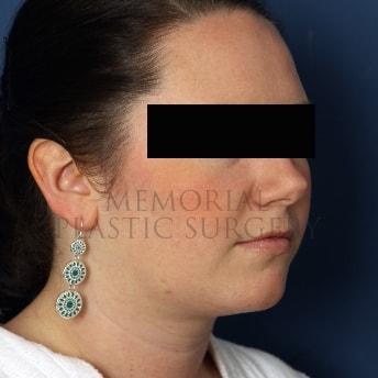 Chin Implant after at Memorial Plastic Surgery in Houston, TX
