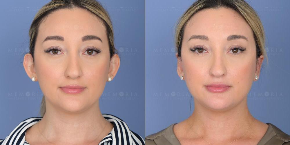 Memorial Plastic Surgery otoplasty result — Houston, TX