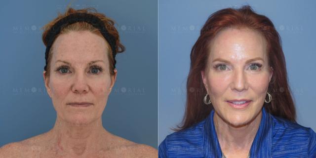 Neck Lift result at Memorial Plastic Surgery in Houston, TX