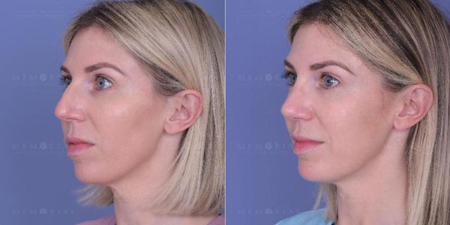 Liquid Rhinoplasty result at Memorial Plastic Surgery in Houston, TX