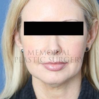 Chin Implant before at Memorial Plastic Surgery in Houston, TX