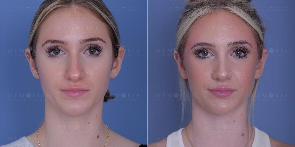 Memorial Plastic Surgery rhinoplasty result — Houston, TX