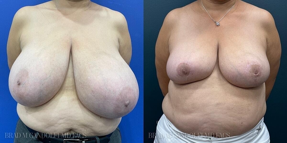 Hudson Plastic Surgery (Brad Gandolfi, MD) breast reduction result — New York, NY