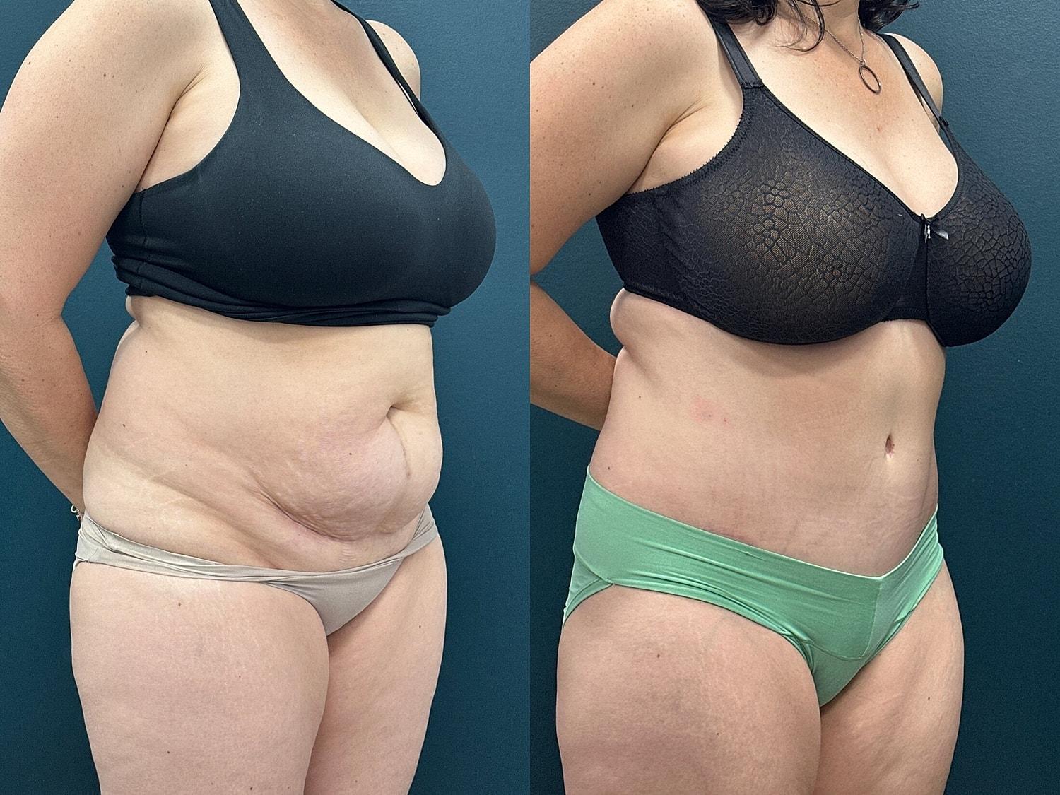 Hudson Plastic Surgery (Brad Gandolfi, MD) tummy tuck result — New York, NY