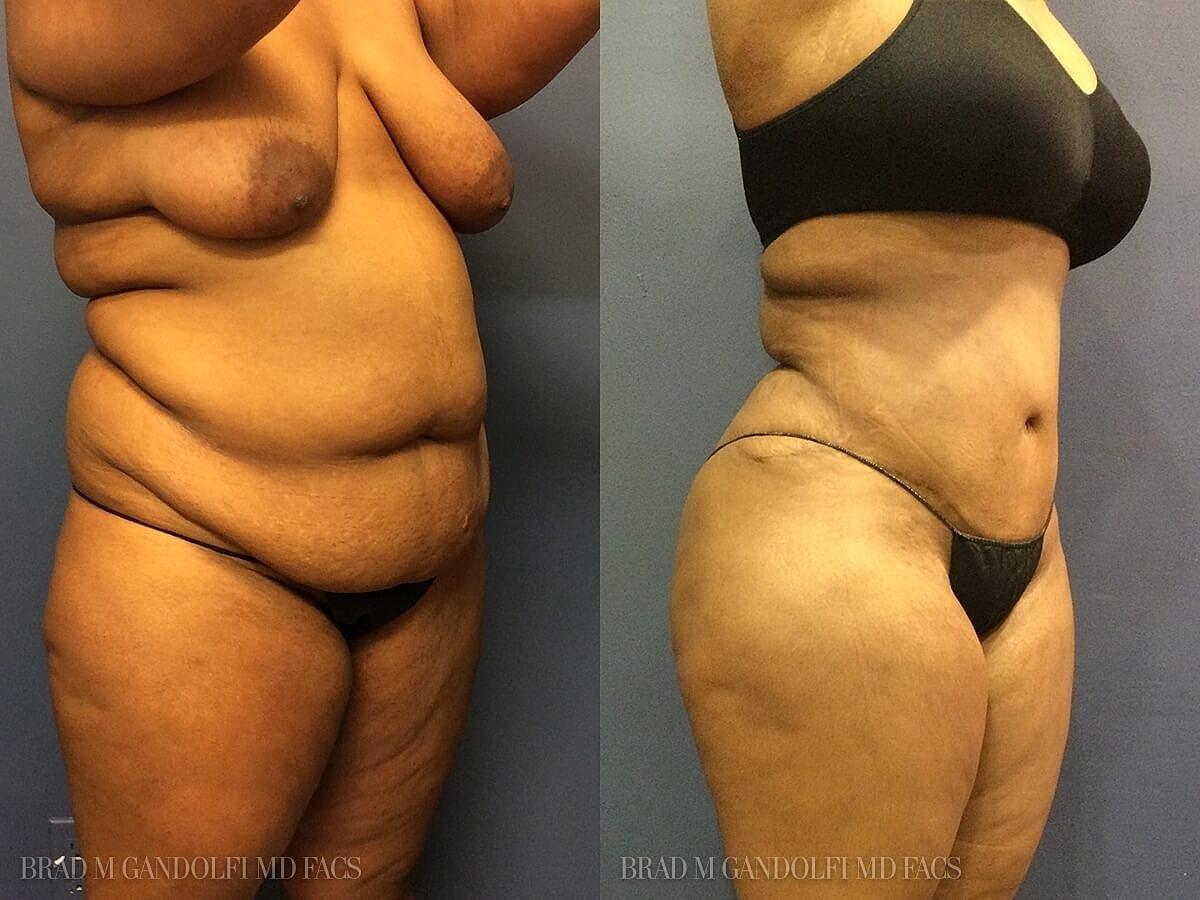 Hudson Plastic Surgery (Brad Gandolfi, MD) tummy tuck result — New York, NY