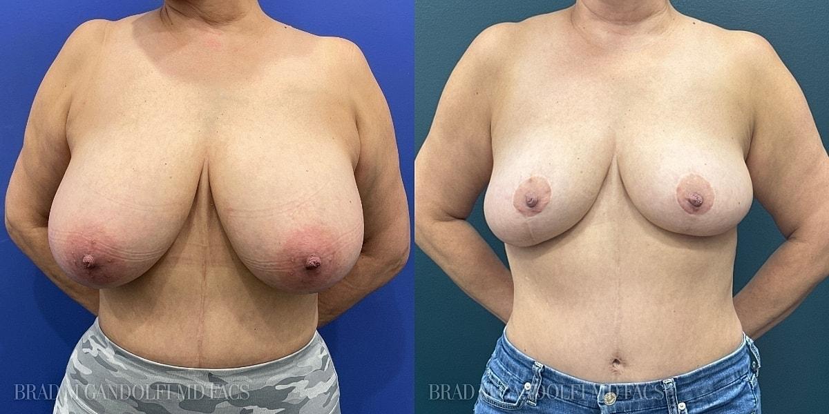 Hudson Plastic Surgery (Brad Gandolfi, MD) breast reduction result — New York, NY