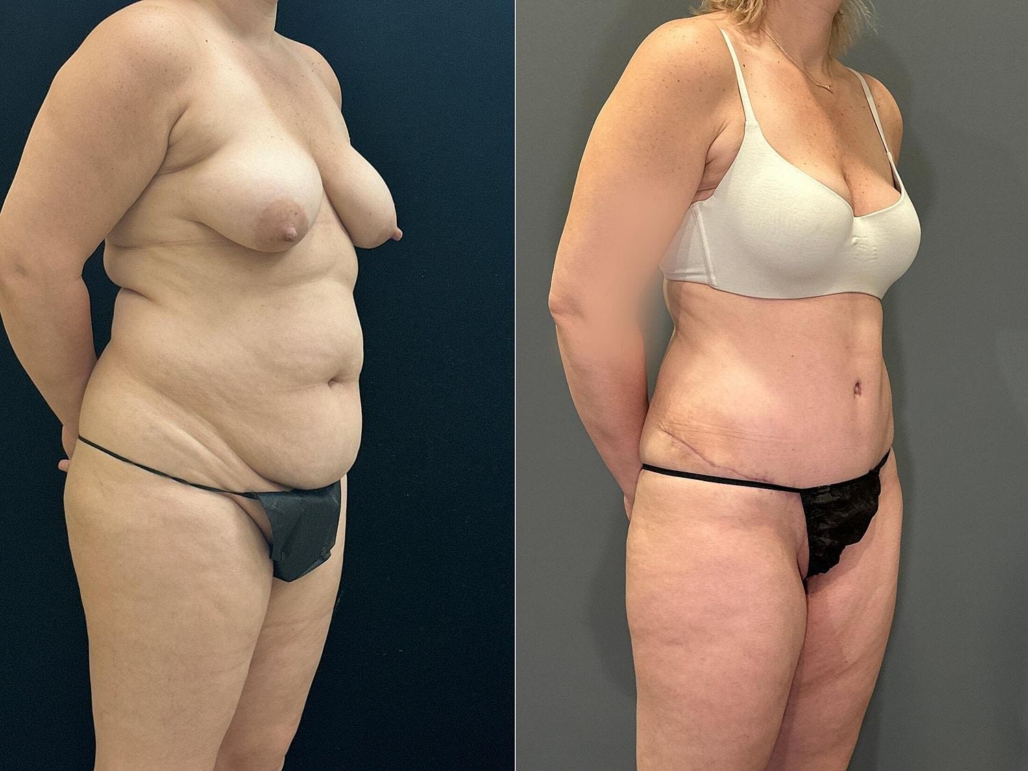 Hudson Plastic Surgery (Brad Gandolfi, MD) tummy tuck result — New York, NY