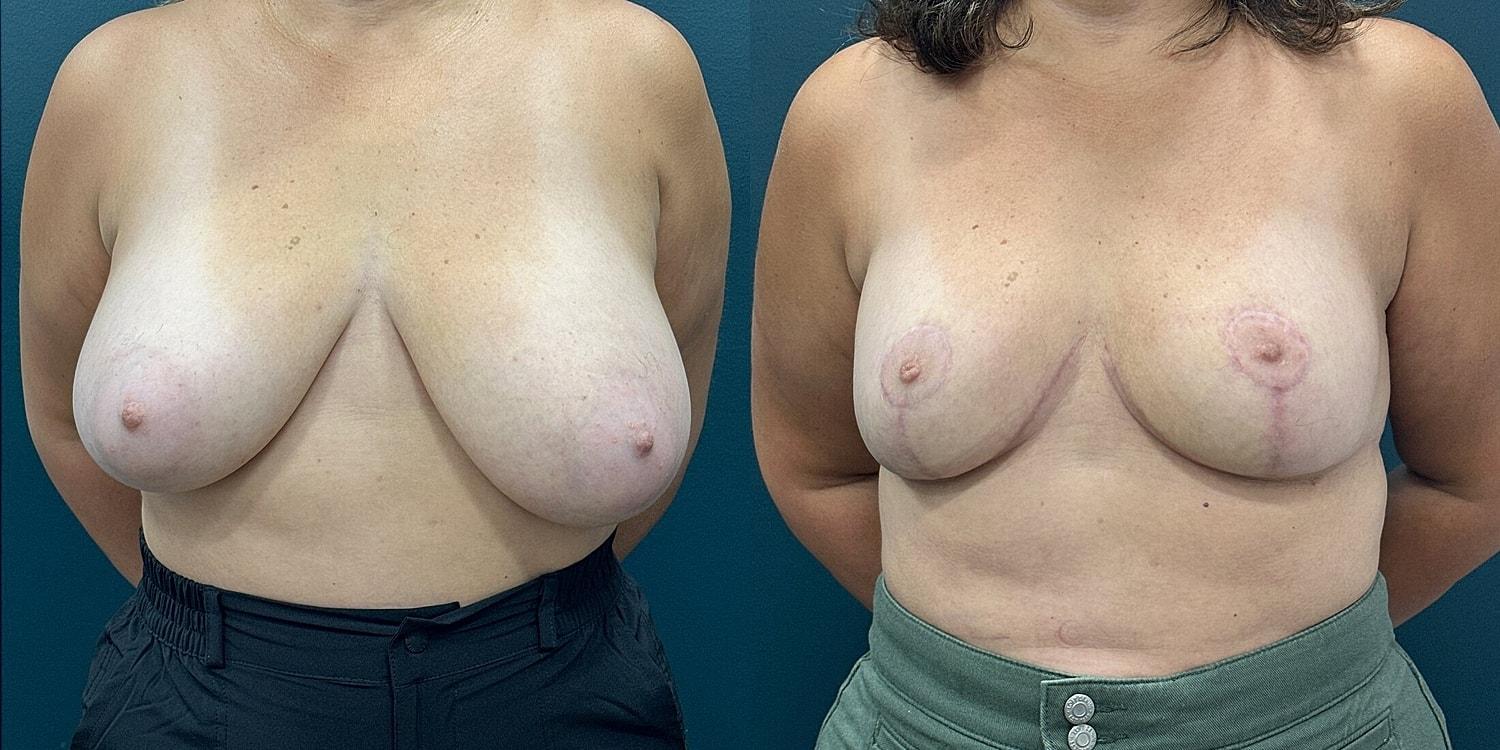 Hudson Plastic Surgery (Brad Gandolfi, MD) breast reduction result — New York, NY
