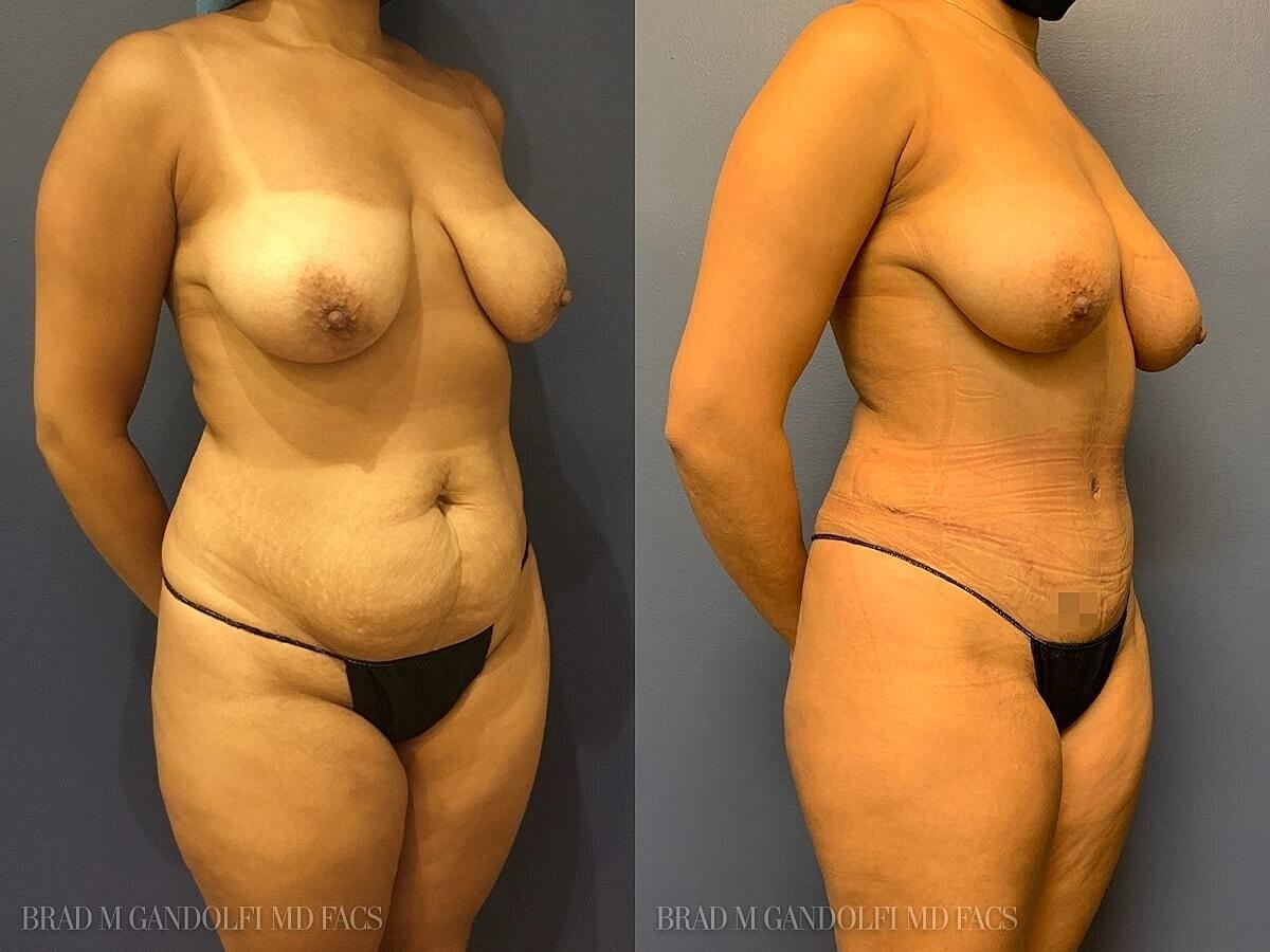 Hudson Plastic Surgery (Brad Gandolfi, MD) tummy tuck result — New York, NY