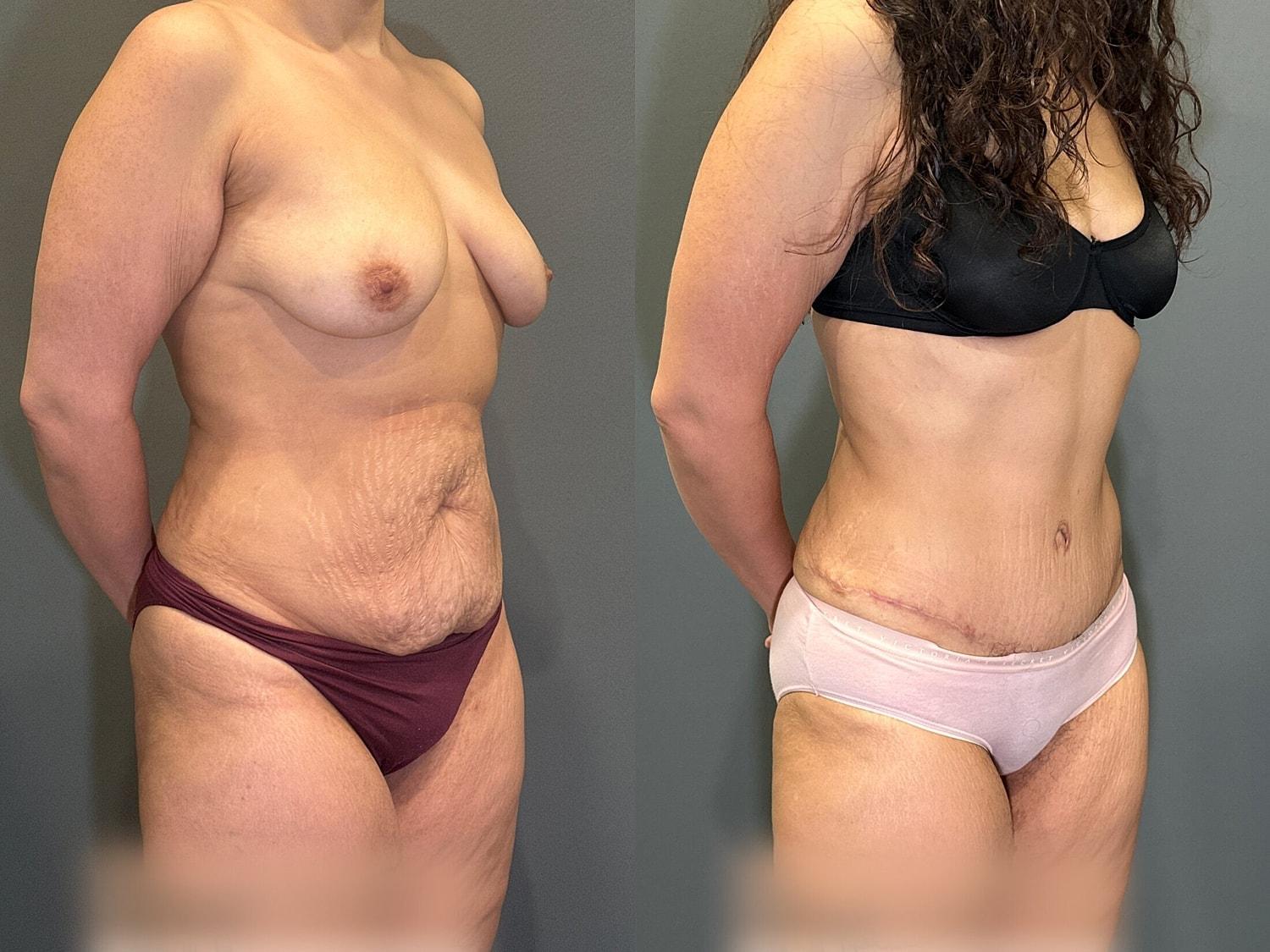 Hudson Plastic Surgery (Brad Gandolfi, MD) tummy tuck result — New York, NY
