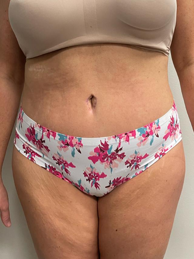 Tummy Tuck after at Ingram Cosmetic Surgery: Alton Ingram, MD in Nashville, TN