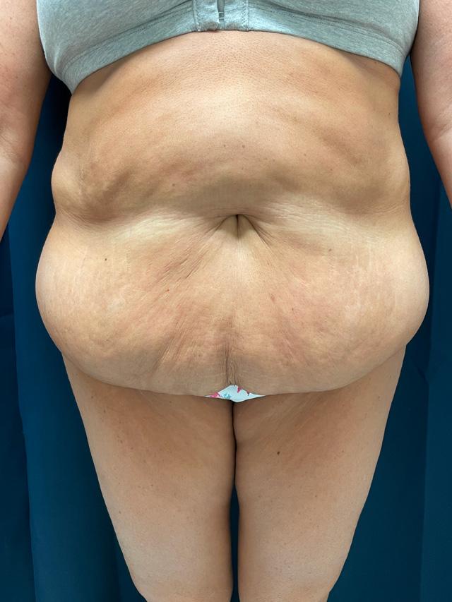 Tummy Tuck before at Ingram Cosmetic Surgery: Alton Ingram, MD in Nashville, TN