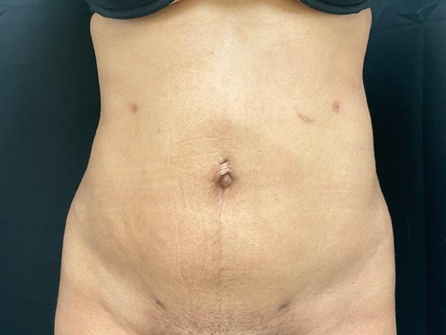 Ingram Cosmetic Surgery: Alton Ingram, MD after — Nashville, TN
