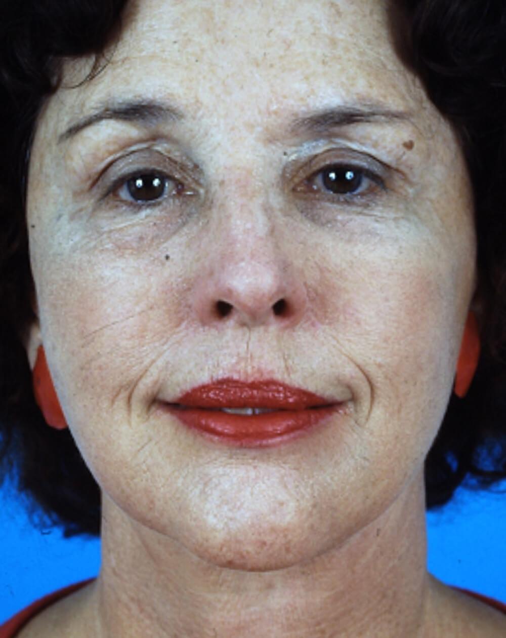 John Minoli, MD facelift after — Las Vegas, NV