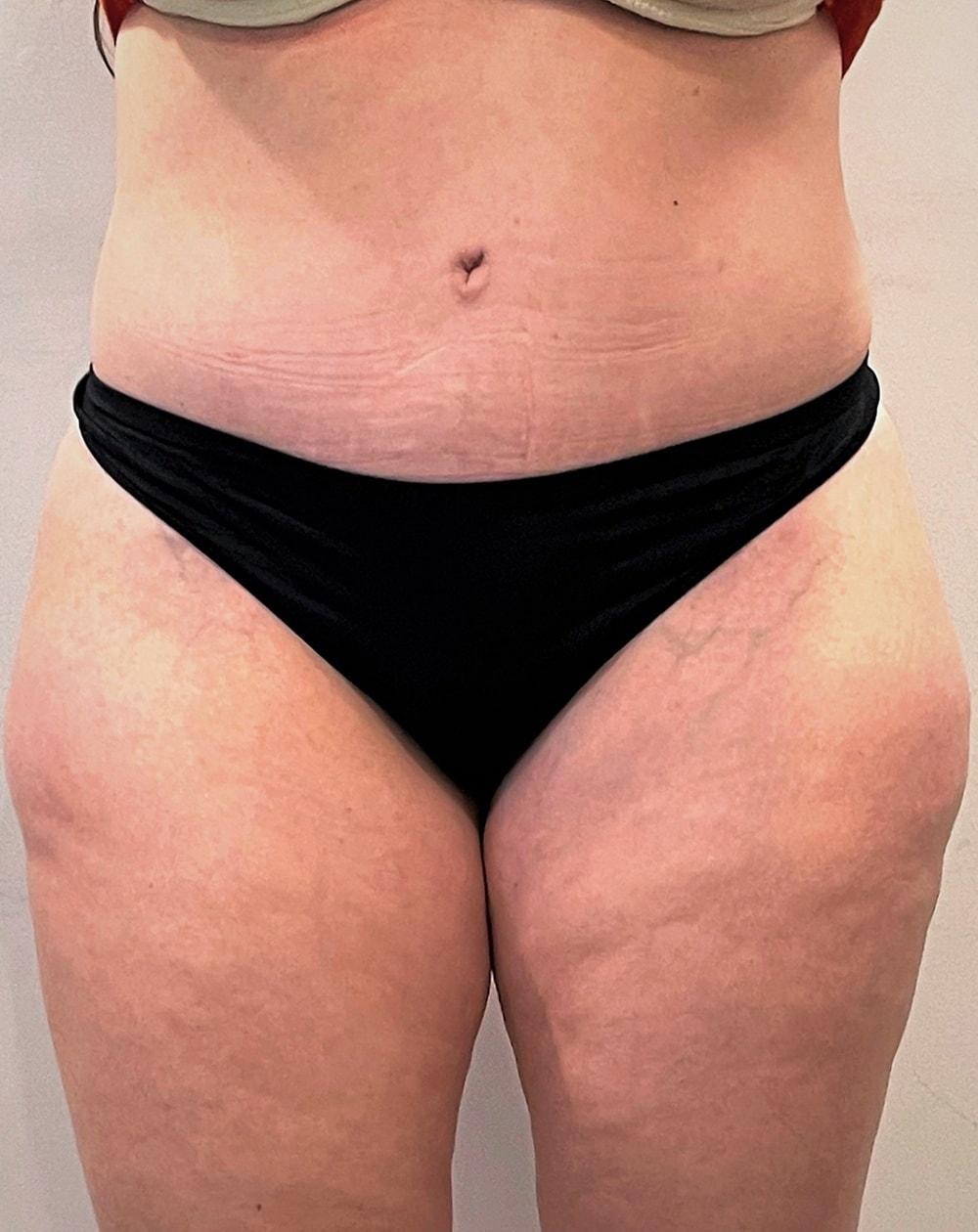 John Minoli, MD tummy tuck after — Las Vegas, NV