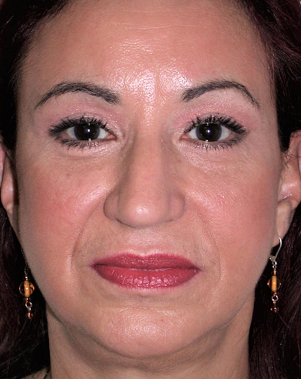 John Minoli, MD facelift after — Las Vegas, NV