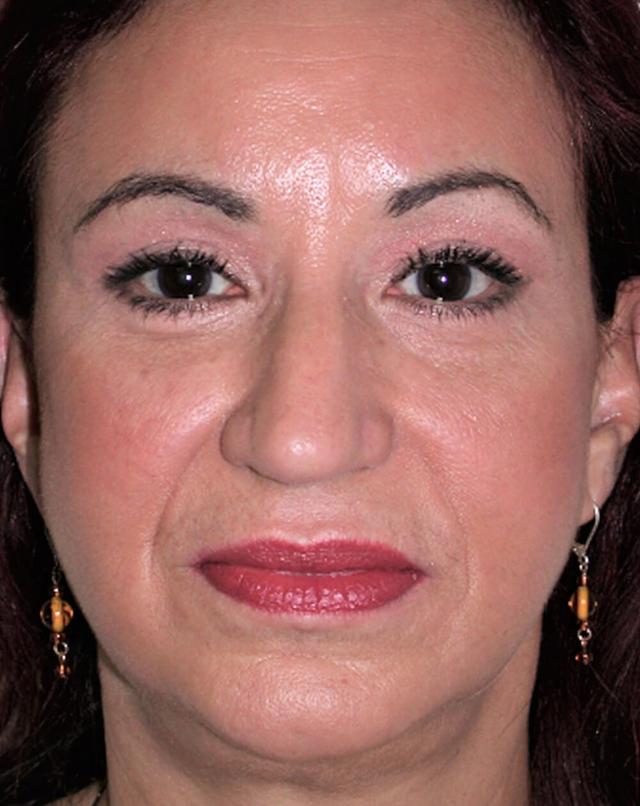 Facelift after at John Minoli, MD in Las Vegas, NV
