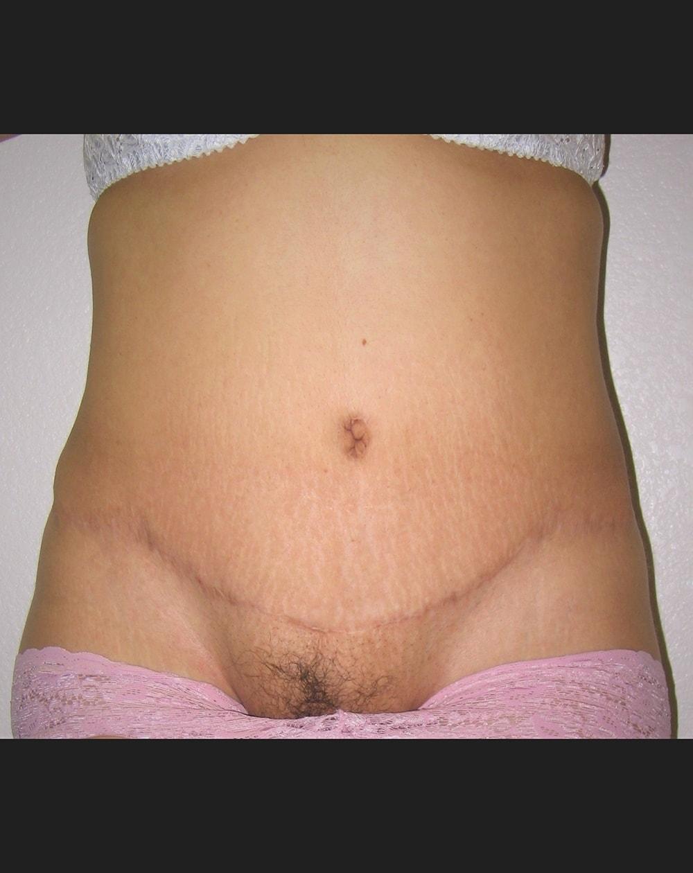 John Minoli, MD tummy tuck after — Las Vegas, NV