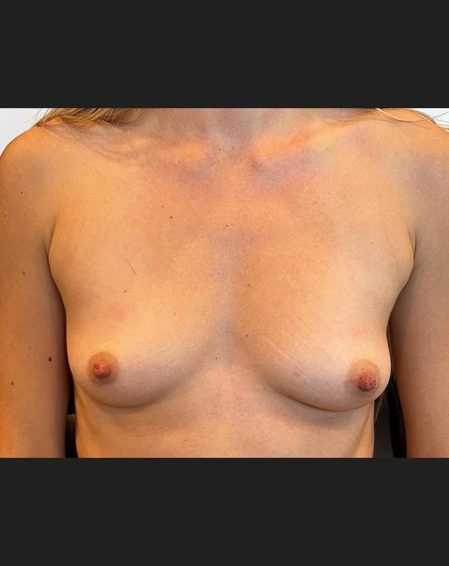 Fat Transfer Breast Augmentation before at John Minoli, MD in Las Vegas, NV