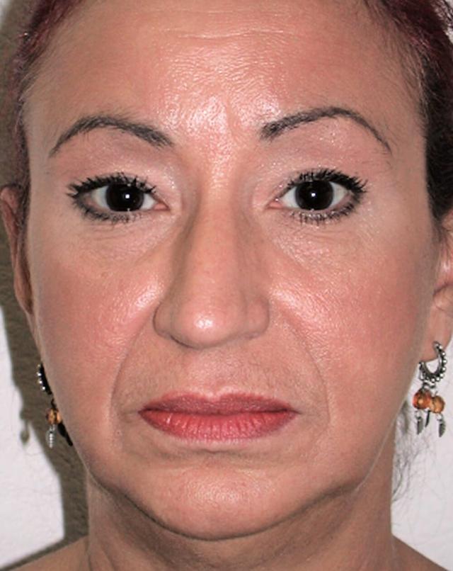 Facelift before at John Minoli, MD in Las Vegas, NV